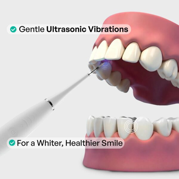 Plaque Blaster | Ultrasonic Plaque Remover - Image 2