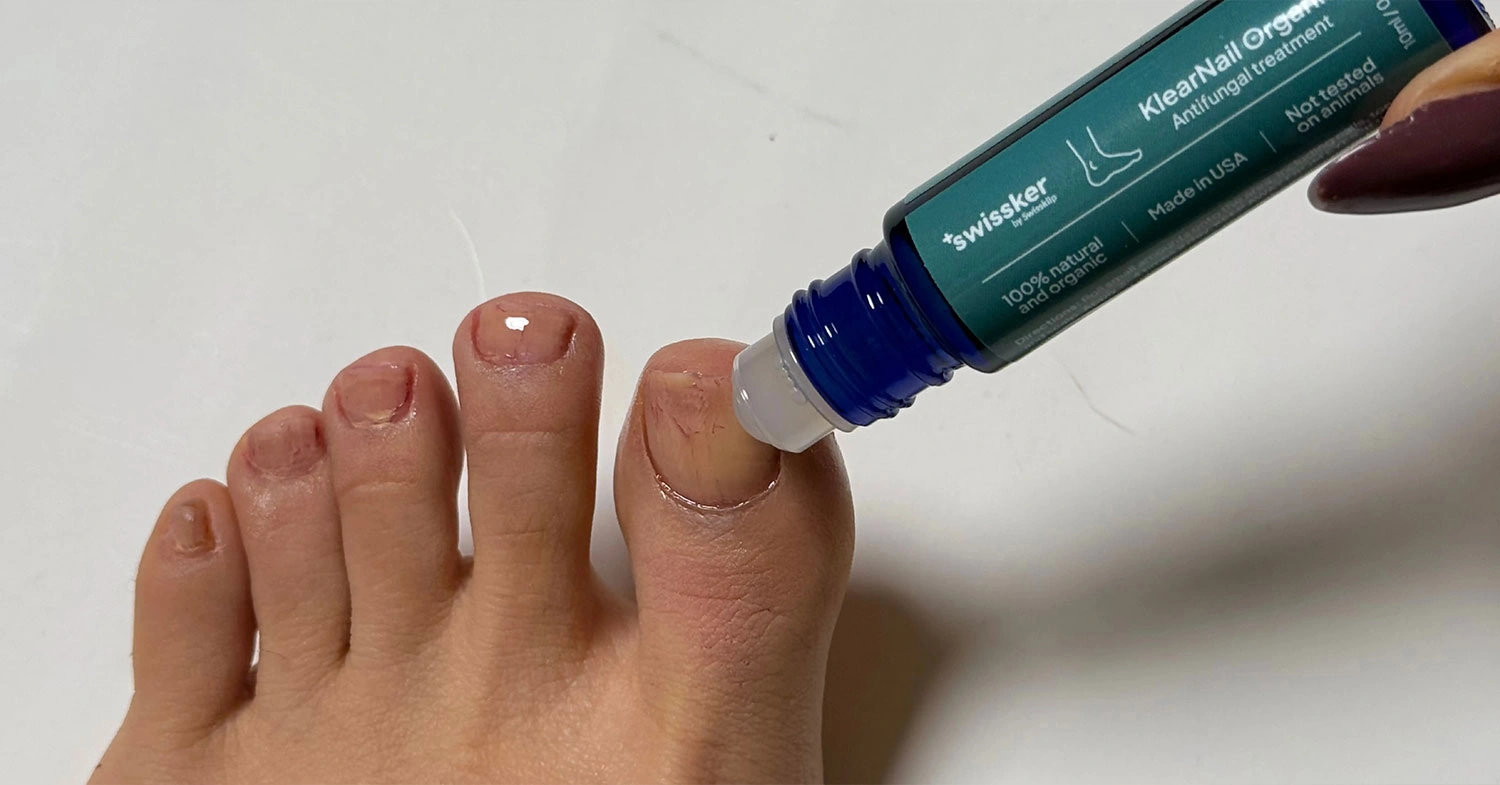 how-to-treat-nail-fungus-easily