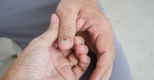 nail-bruise-vs-nail-fungus