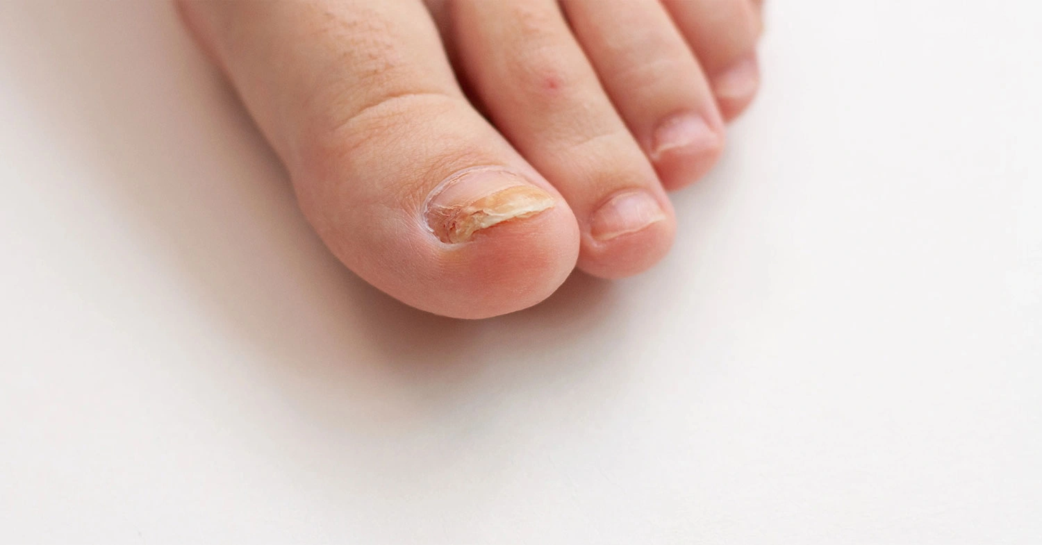 stages-of-toenail-fungus