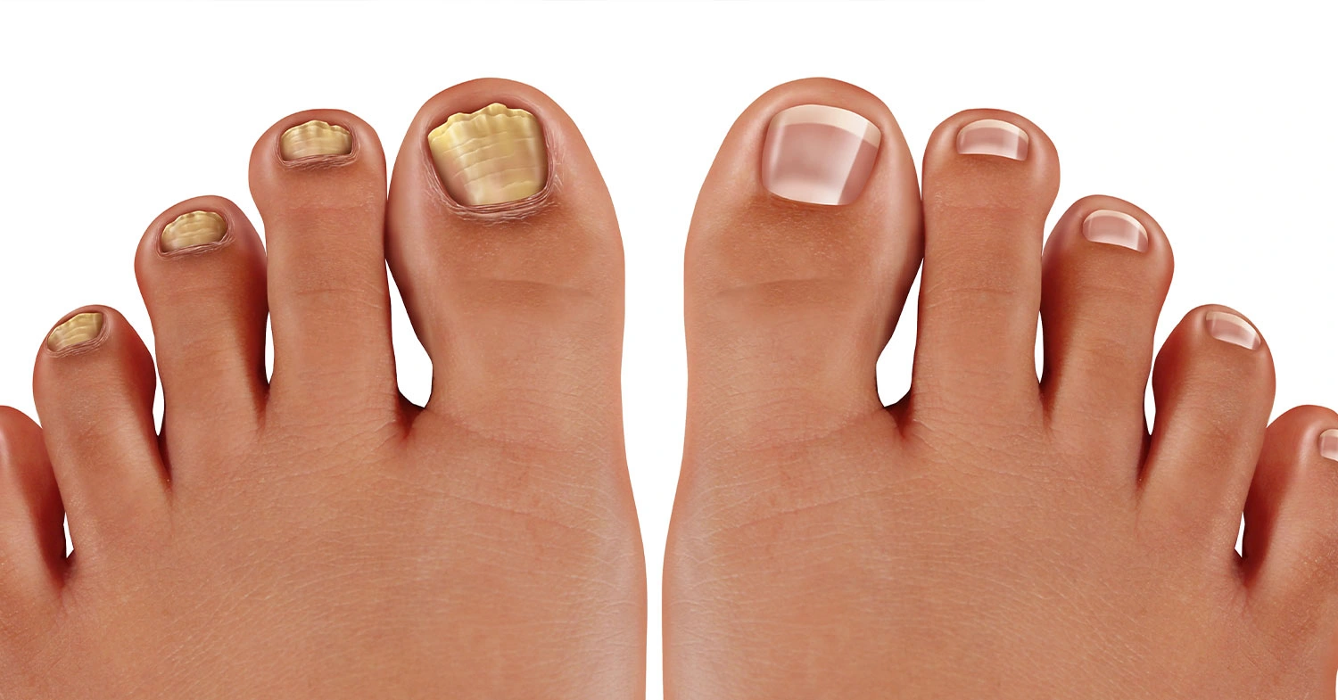 toenail-discoloration