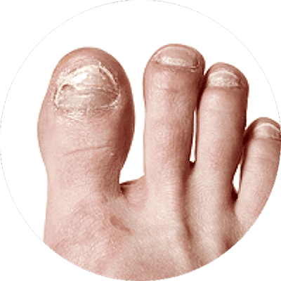 Ingrown nails