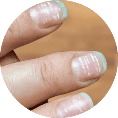 Brittle nails