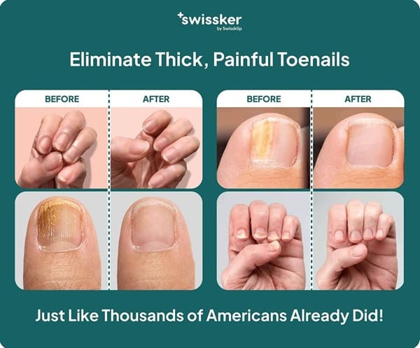 Swissker Nail Treatment Result