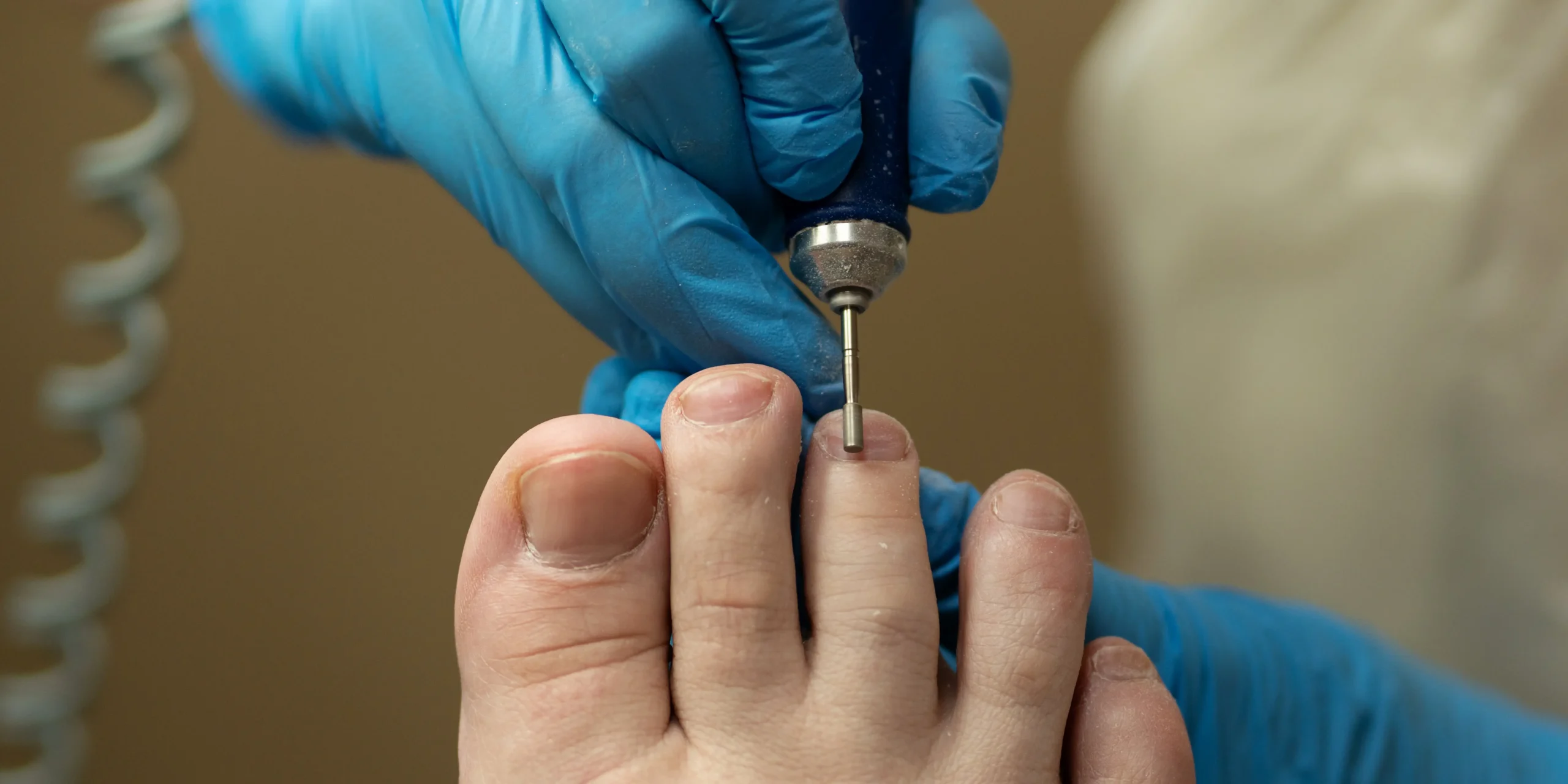 Nail Psoriasis vs Fungus