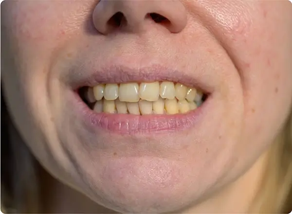 Applying Swissker bottle