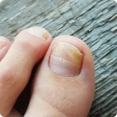 Ingrown Toenail
